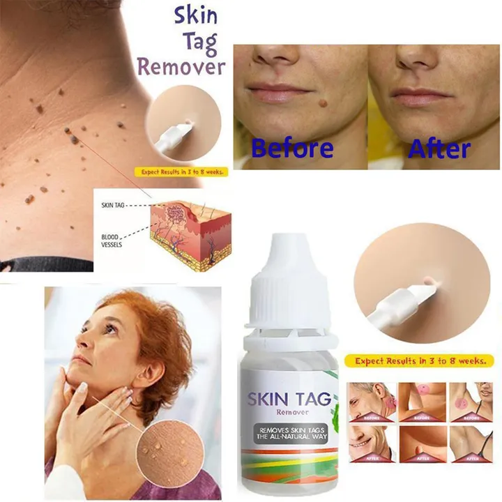 10ml-wart-treatment-skin-tag-remover-instant-removal-molepapillomas-foot-corn-repair-tool-anti-verruca-remedy-ointment-1pc