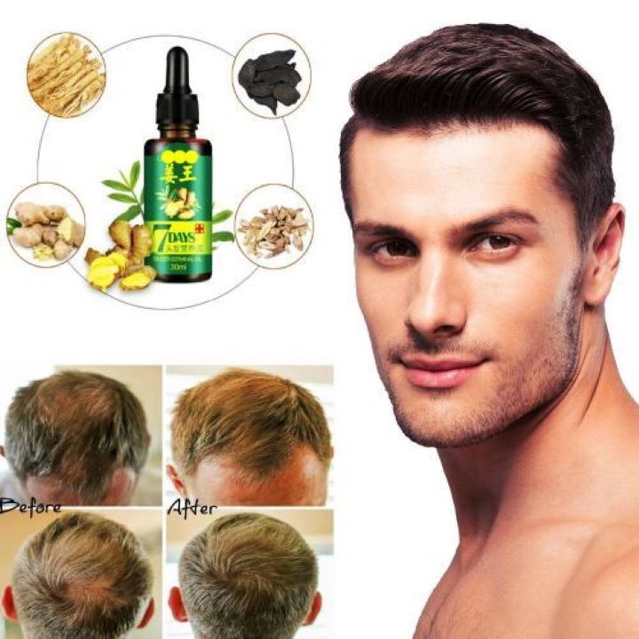 ocarly-hair-growth-loss-serum-men-women-7day-tonic-ginger-germinal-oil