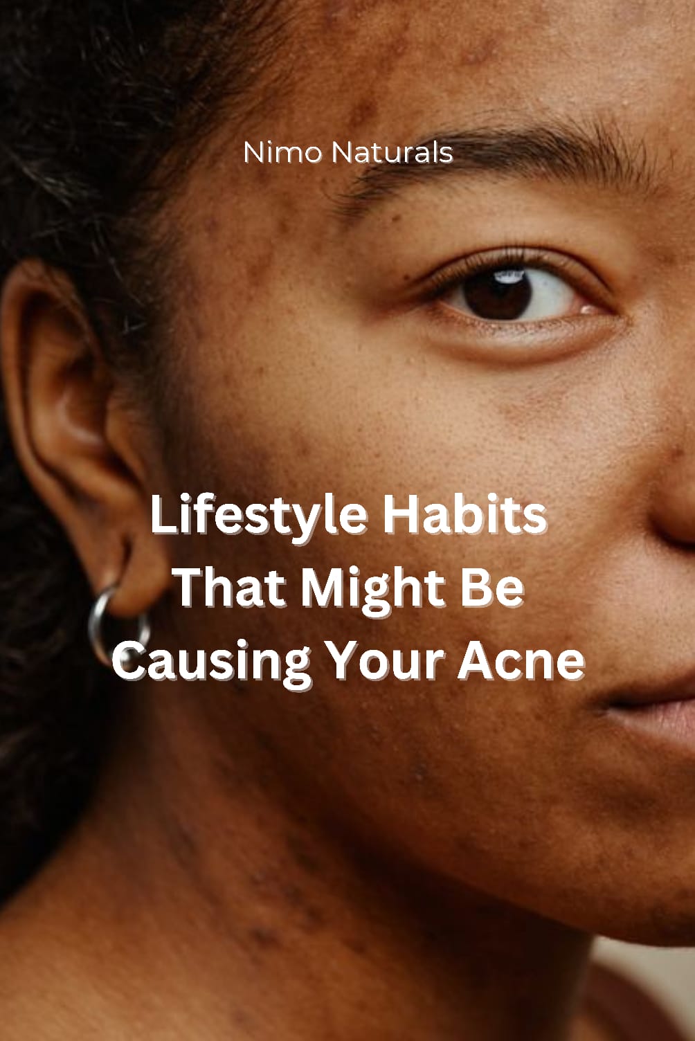 LIFESTYLE HABITS THAT MIGHT BE CAUSING YOUR ACNE